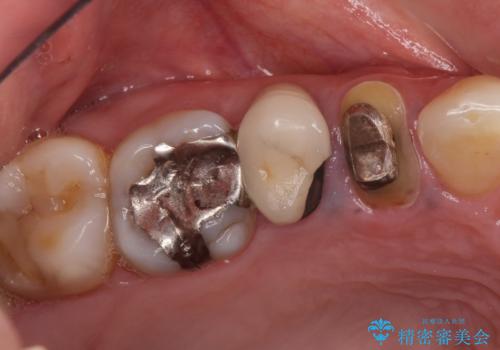 治療途中で放置していた歯 オールセラミッククラウンによる補綴治療の症例 治療前