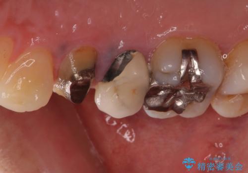 治療途中で放置していた歯 オールセラミッククラウンによる補綴治療の治療前