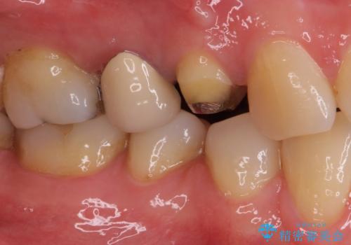 治療途中で放置していた歯 オールセラミッククラウンによる補綴治療の治療前