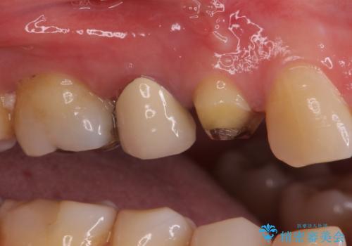 治療途中で放置していた歯 オールセラミッククラウンによる補綴治療の治療前