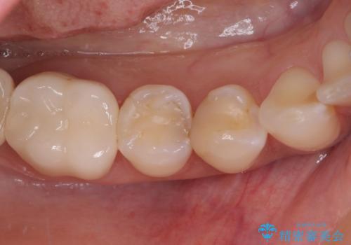 奥歯がしみる　セラミックインレーによるむし歯治療の症例 治療前
