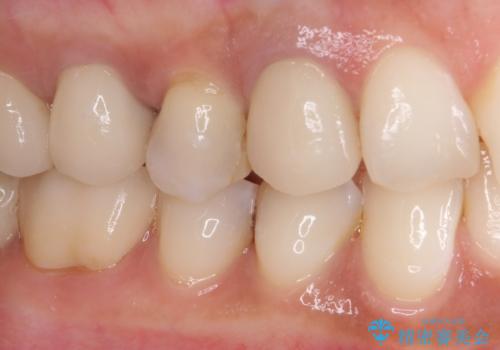 奥歯がしみる セラミックインレーによるむし歯治療の治療前