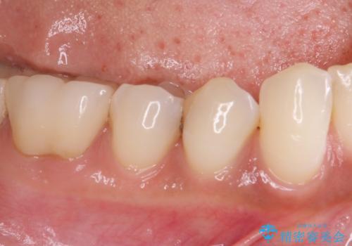 奥歯がしみる セラミックインレーによるむし歯治療の治療前
