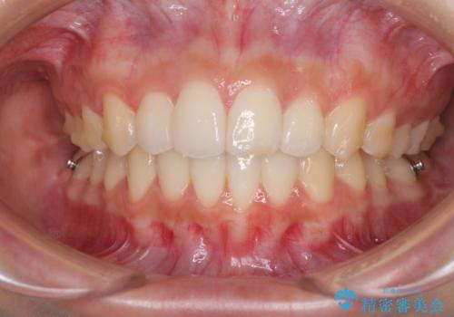 前歯のデコボコと突出感 インビザラインで改善の治療中