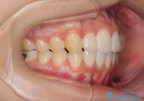 前歯のデコボコと突出感 インビザラインで改善の治療中