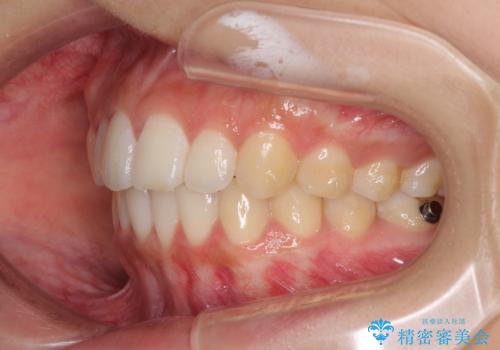 前歯のデコボコと突出感 インビザラインで改善の治療中