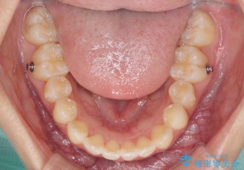 前歯のデコボコと突出感 インビザラインで改善の治療中