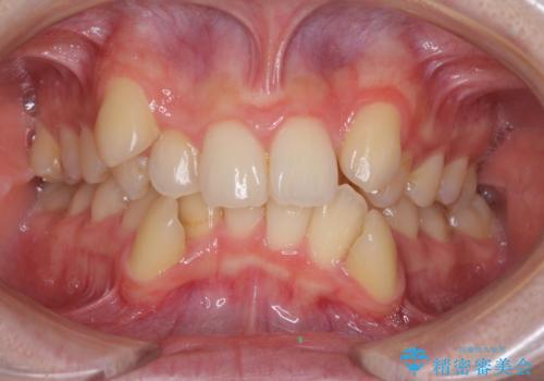 気になる八重歯を治したい ワイヤー装置での抜歯矯正の症例 治療前