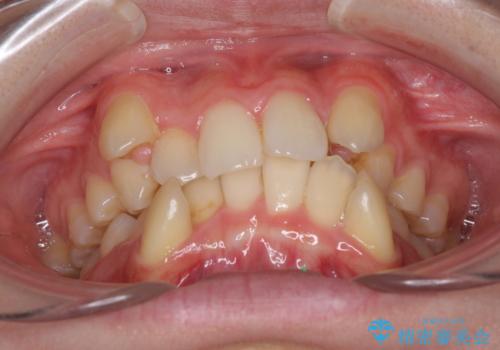 気になる八重歯を治したい ワイヤー装置での抜歯矯正の治療前