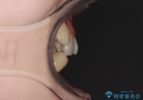 気になる八重歯を治したい ワイヤー装置での抜歯矯正の治療前