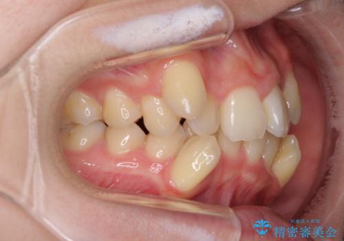 気になる八重歯を治したい ワイヤー装置での抜歯矯正の治療前