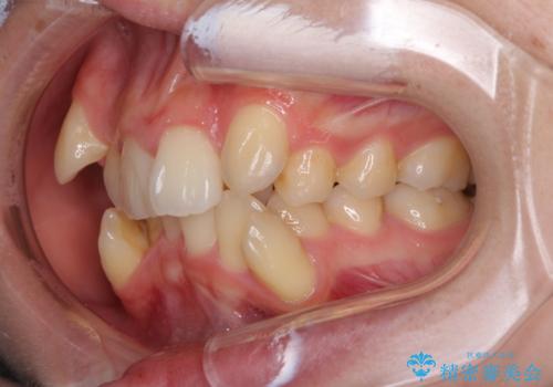 気になる八重歯を治したい ワイヤー装置での抜歯矯正の治療前