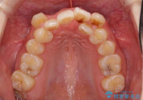 気になる八重歯を治したい ワイヤー装置での抜歯矯正の治療前