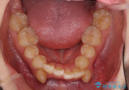 気になる八重歯を治したい ワイヤー装置での抜歯矯正の治療前