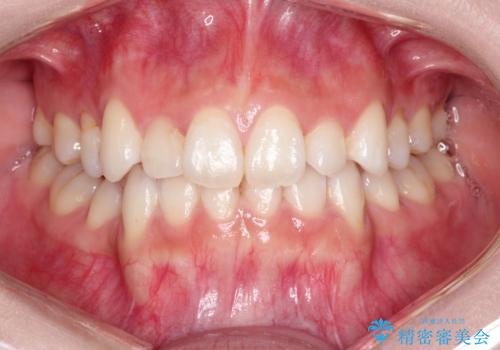 前歯の後戻りを部分矯正で整った歯並びへの症例 治療前