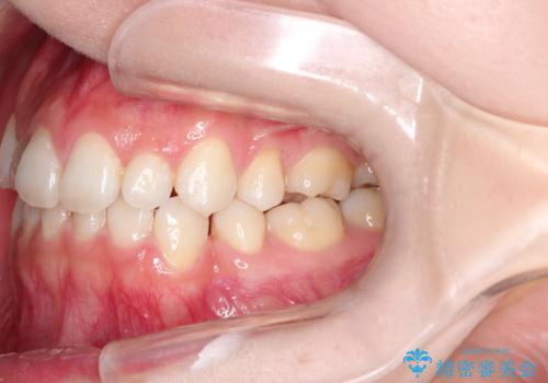 前歯の後戻りを部分矯正で整った歯並びへの治療前