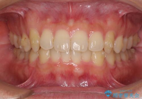 前歯の咬み合わせとデコボコを解消　インビザラインによる矯正治療の治療中