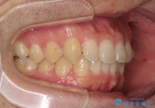 前歯の咬み合わせとデコボコを解消 インビザラインによる矯正治療の治療中