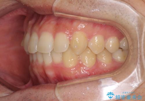 前歯の咬み合わせとデコボコを解消 インビザラインによる矯正治療の治療中