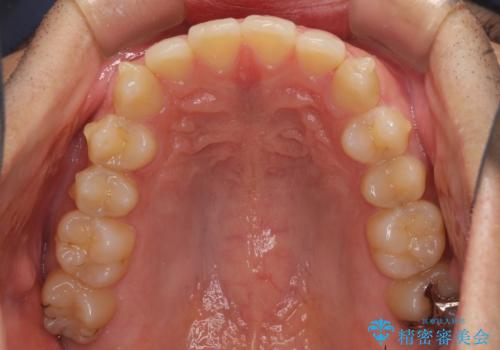 前歯の咬み合わせとデコボコを解消 インビザラインによる矯正治療の治療中