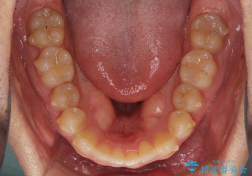 前歯の咬み合わせとデコボコを解消　インビザラインによる矯正治療の治療中