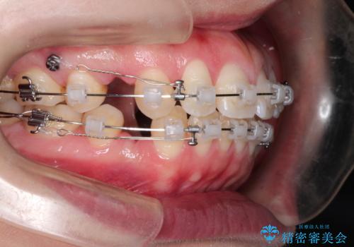 [口ゴボ] 口元が出ているのが気になる　ワイヤーによる抜歯矯正で口元をすっきりとの治療中