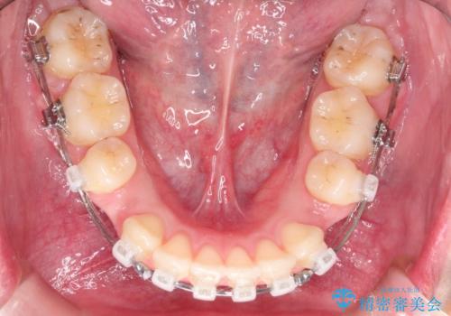 [口ゴボ] 口元が出ているのが気になる　ワイヤーによる抜歯矯正で口元をすっきりとの治療中