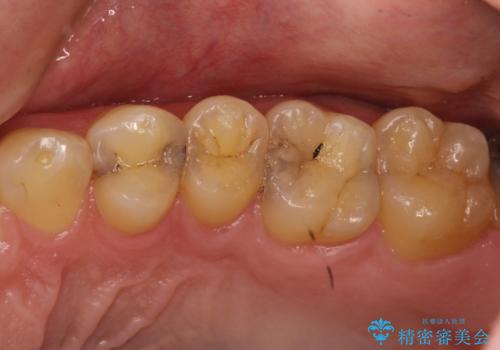 虫歯を治したい、セラミックによる治療の症例 治療前