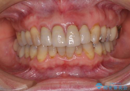 折れてしまった前歯 インプラントによる補綴治療の治療前