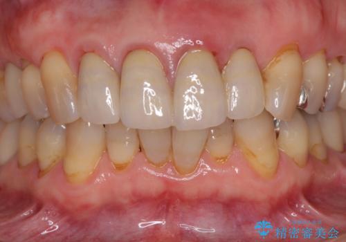 折れてしまった前歯 インプラントによる補綴治療の治療前