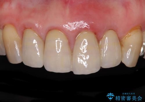 折れてしまった前歯 インプラントによる補綴治療の症例 治療前