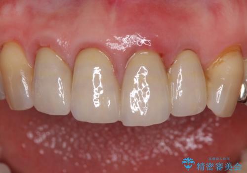 折れてしまった前歯 インプラントによる補綴治療の治療前