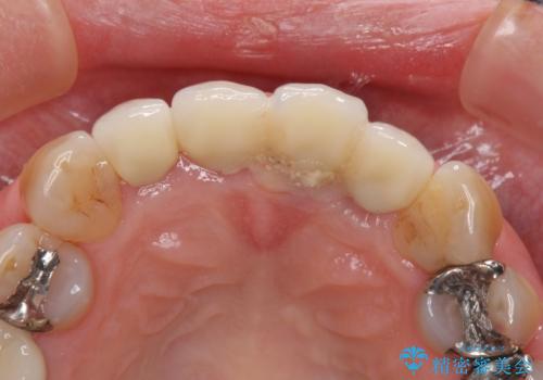 折れてしまった前歯 インプラントによる補綴治療の治療前