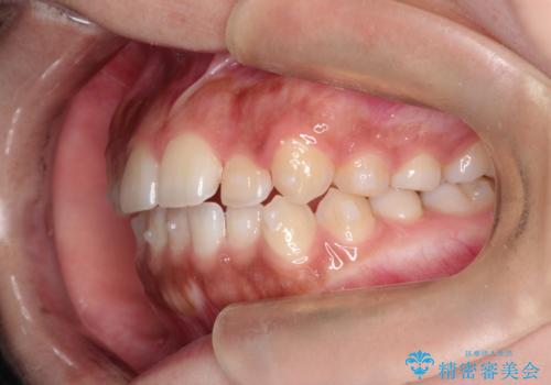 インビザライン 前歯のがたつきを目立たず矯正の治療中