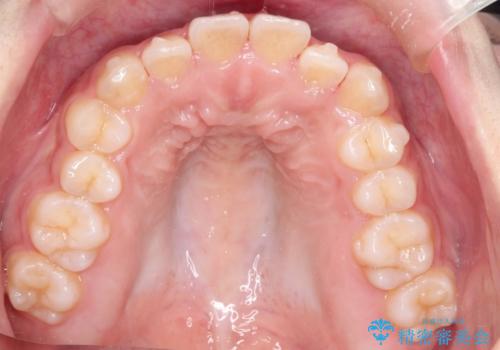 インビザライン　前歯のがたつきを目立たず矯正の治療中