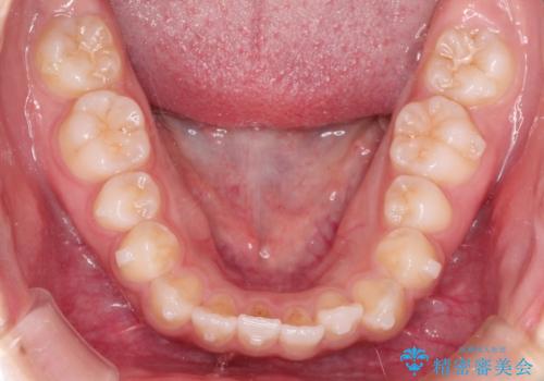 インビザライン 前歯のがたつきを目立たず矯正の治療中