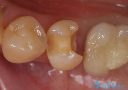 セラミックインレー 気になる銀歯を白くの治療中