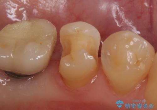 セラミックインレー 気になる銀歯を白くの治療中