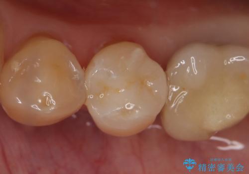 セラミックインレー 気になる銀歯を白くの症例 治療後