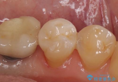 セラミックインレー 気になる銀歯を白くの治療後