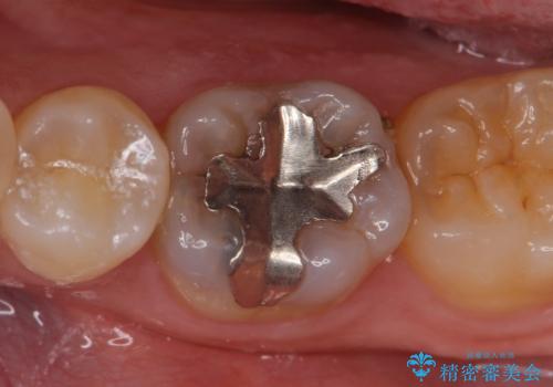 セラミックインレー しみる奥歯の治療の症例 治療前