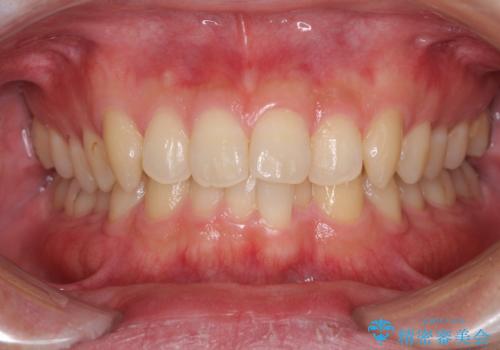 前歯の咬み合わせとデコボコを解消 インビザラインによる矯正治療の症例 治療前