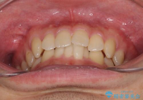 前歯の咬み合わせとデコボコを解消　インビザラインによる矯正治療の治療前