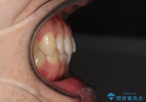 前歯の咬み合わせとデコボコを解消 インビザラインによる矯正治療の治療前