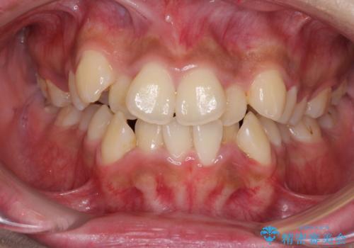 口元をスッキリと ワイヤーでの抜歯矯正の治療前