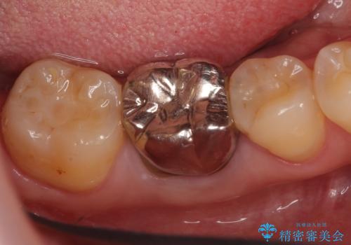 オールセラミッククラウン 鈍い痛みが続く奥歯の治療の症例 治療前