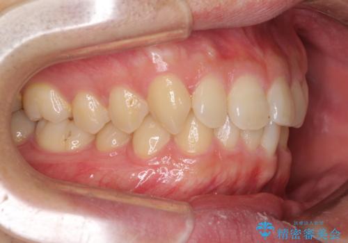 前歯の咬み合わせとデコボコを解消　インビザラインによる矯正治療の治療前