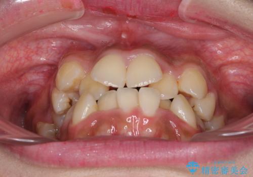 口元をスッキリと ワイヤーでの抜歯矯正の治療前