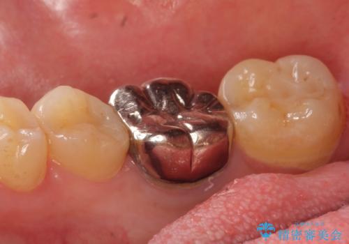 オールセラミッククラウン 鈍い痛みが続く奥歯の治療の治療前