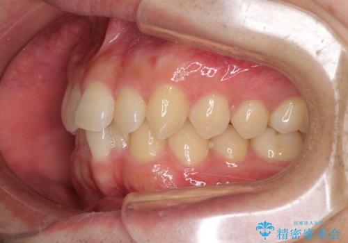 前歯の咬み合わせとデコボコを解消 インビザラインによる矯正治療の治療前